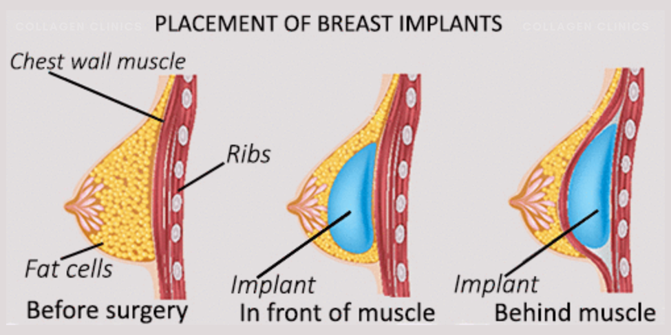 breast implant placement