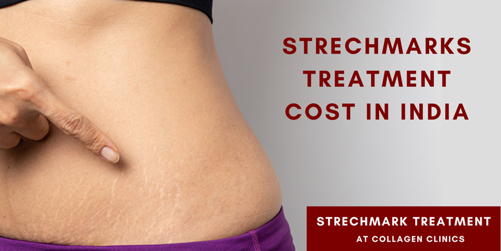 Strech Mark Treatment In Jaipur