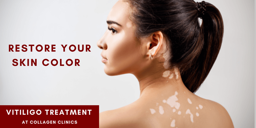Vitiligo Treatment in Jaipur 