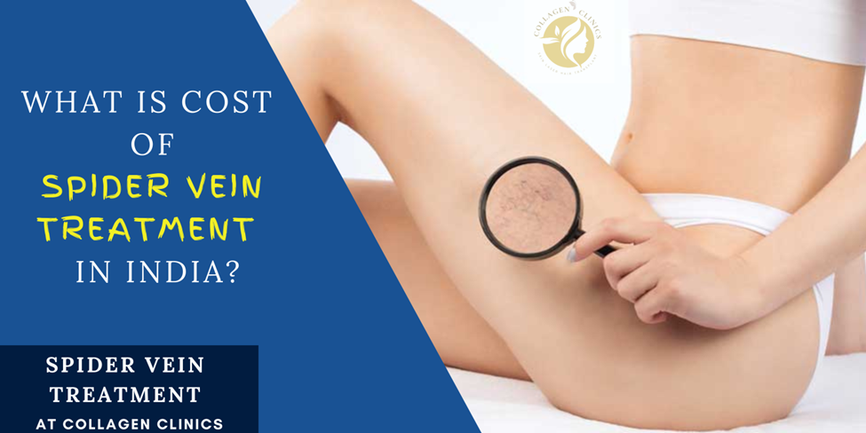 Spider Veins Treatment cost in Jaipur