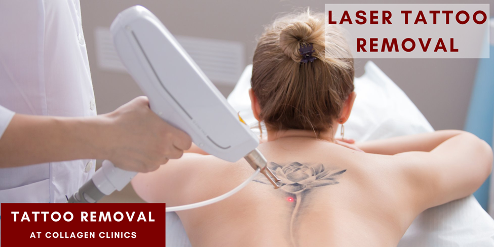 laser tattoo removal in jaipur