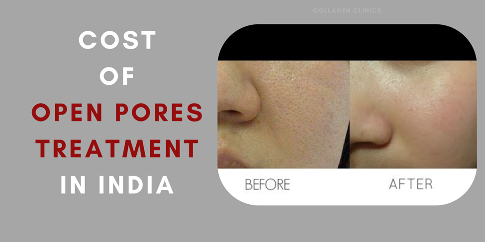 Open Pores Treatment cost in jaipur