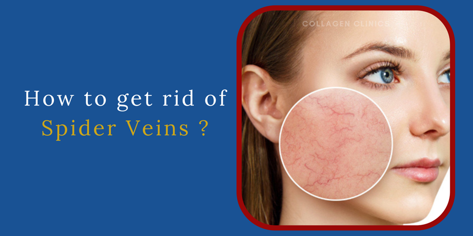 Spider Veins Treatment in Jaipur