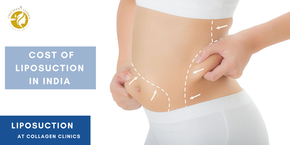 cost of liposuction treatment in jaipur