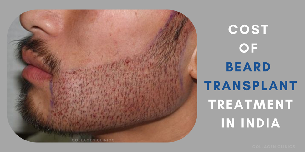 cost of beard transplant