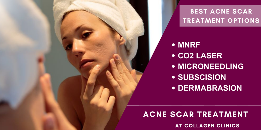acne scars treatments in jaipur