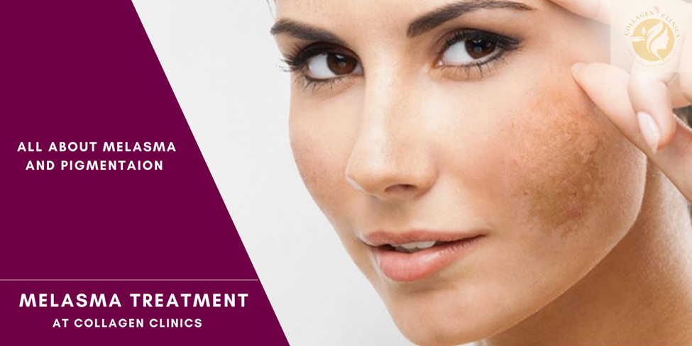 melasma treatment in jaipur