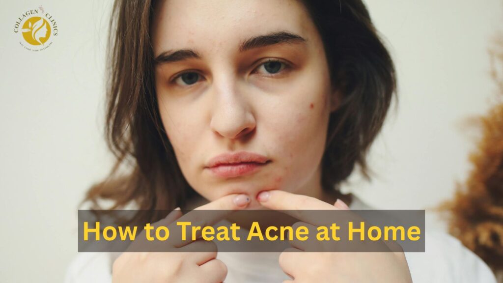 How to treat acne at home How to treat acne at home