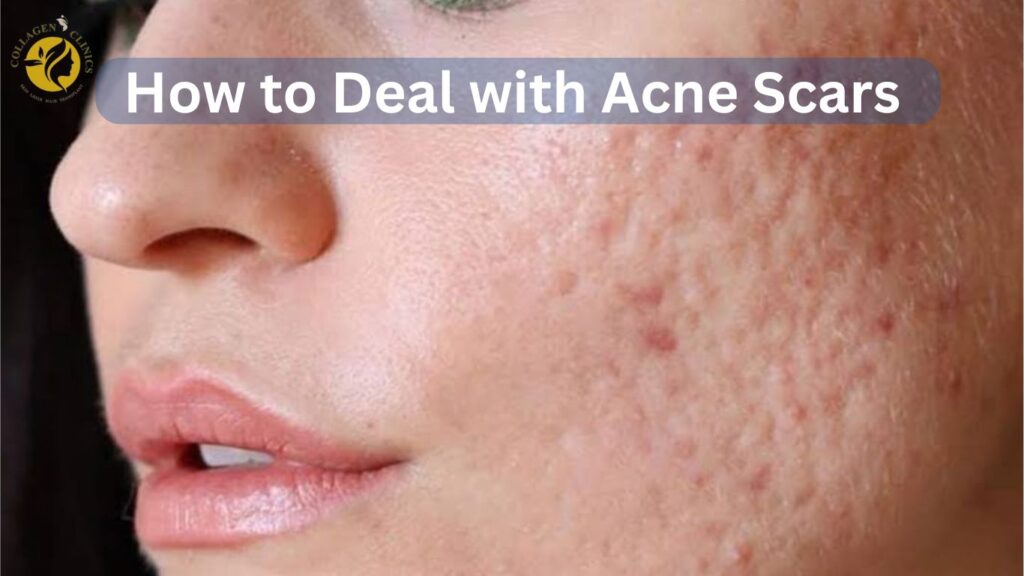 best Acne scar treatment in jaipur