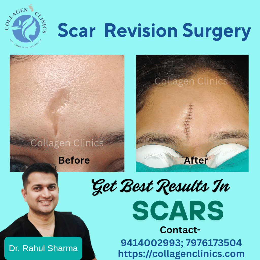 Scar Revision Treatment in Jaipur