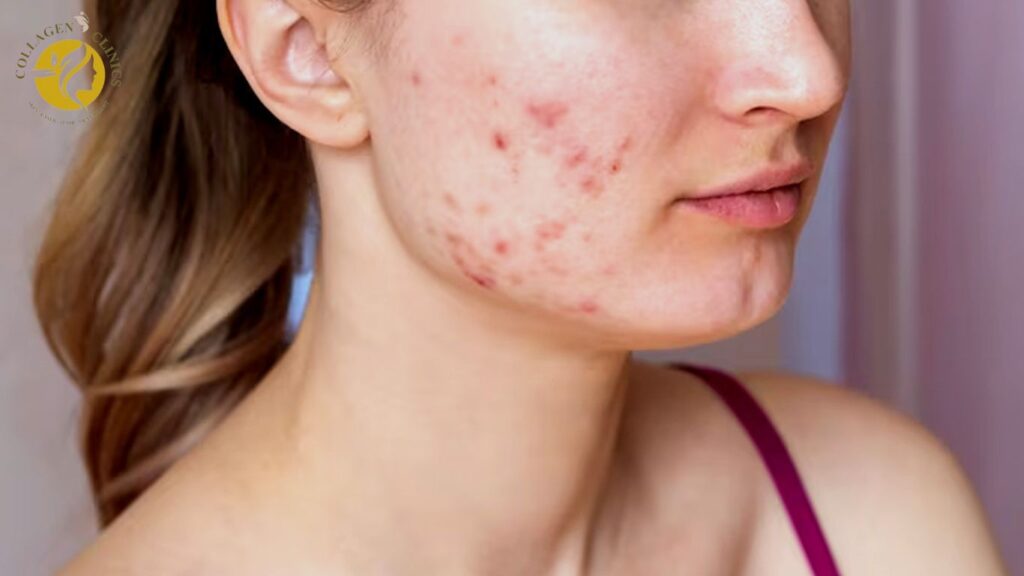 Best acne treatment in jaipur 2